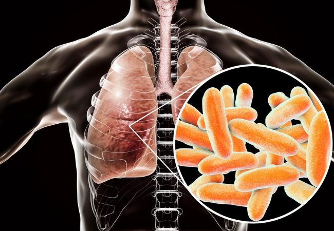 Legionella bacteria in lungs